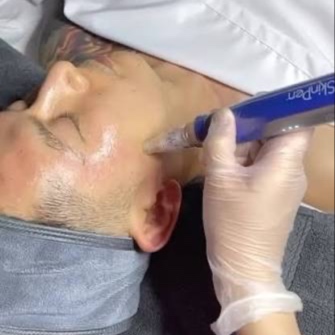 SkinPen Microneedling at The Skin Concierge in Northbrook, IL