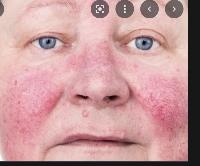 Rosacea Facial