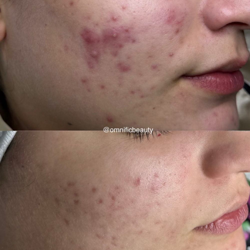 ACNE BOOTCAMP🪞$99-$147 at Omnific Beauty By Nelly in Selma, CA