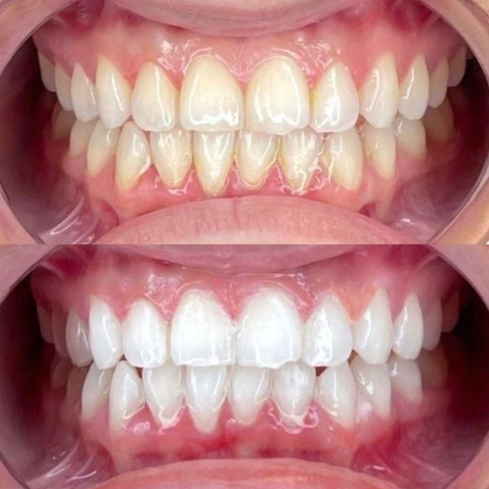 Teeth Whitening at Serene Studios in Sigel, IL
