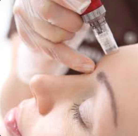 MICRONEEDLING