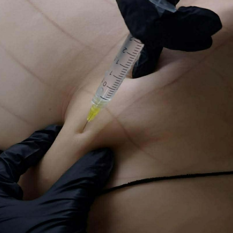 Lipolyis at Elevé Body Aesthetics in Milliken, CO