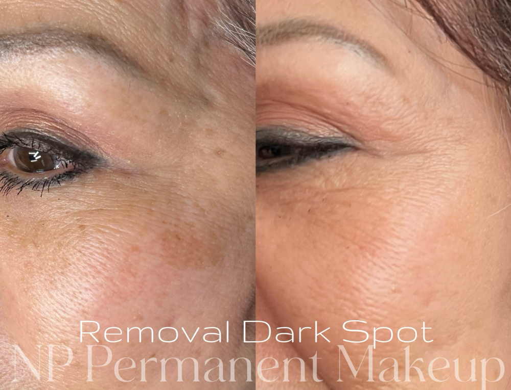 Laser Dark Spot Removal at NP Permanent Makeup in Oklahoma, OK