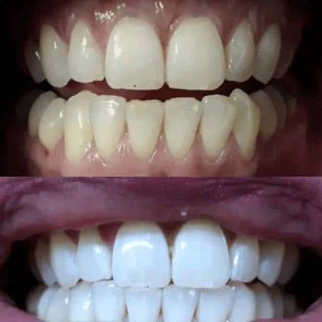 Teeth Whitening at Xo, Lu in Clyde, OH