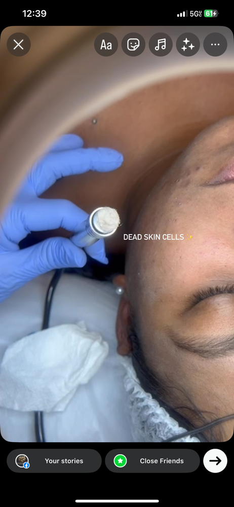 Microdermabrasion