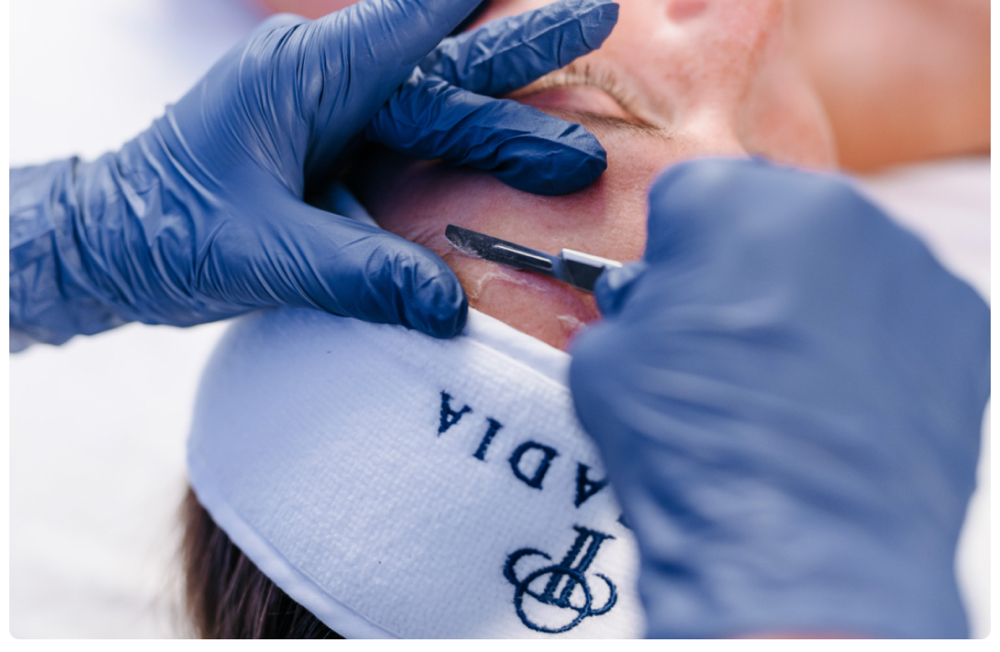 Dermaplaning Added On at Siren Aesthetics & Spa in Greenfield, IN