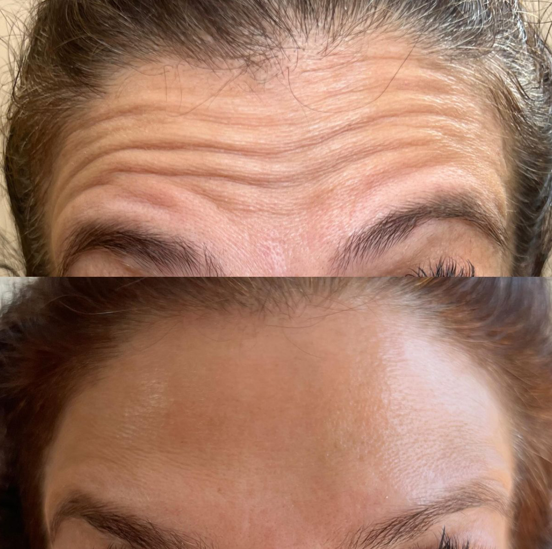 10-30 Units of Xeomin