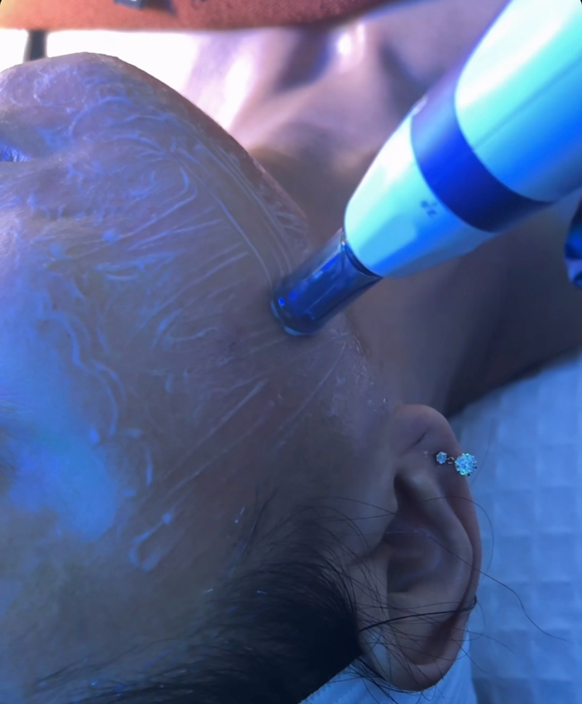Microneedling