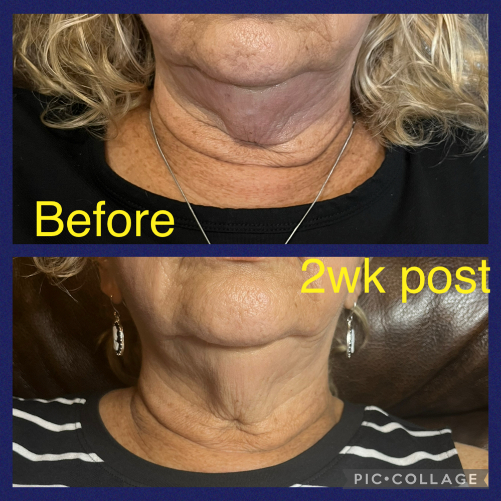 Fat Dissolving Injections