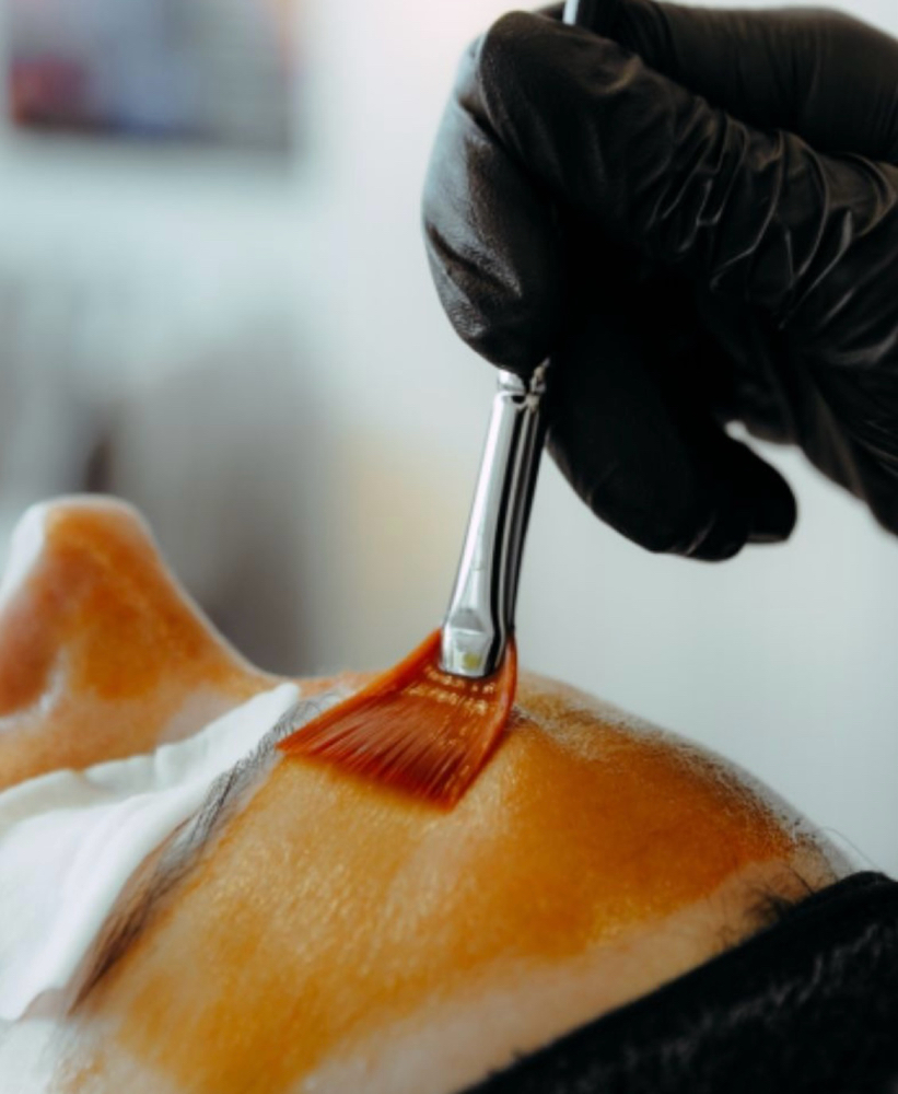 Peel Treatment