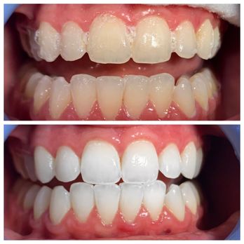 FULL COMPLETE TREATMENT