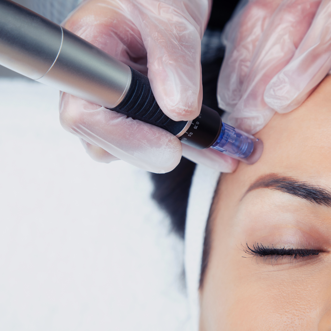 Microneedling