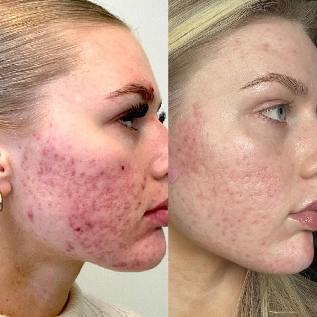 Acne-Focused Peel