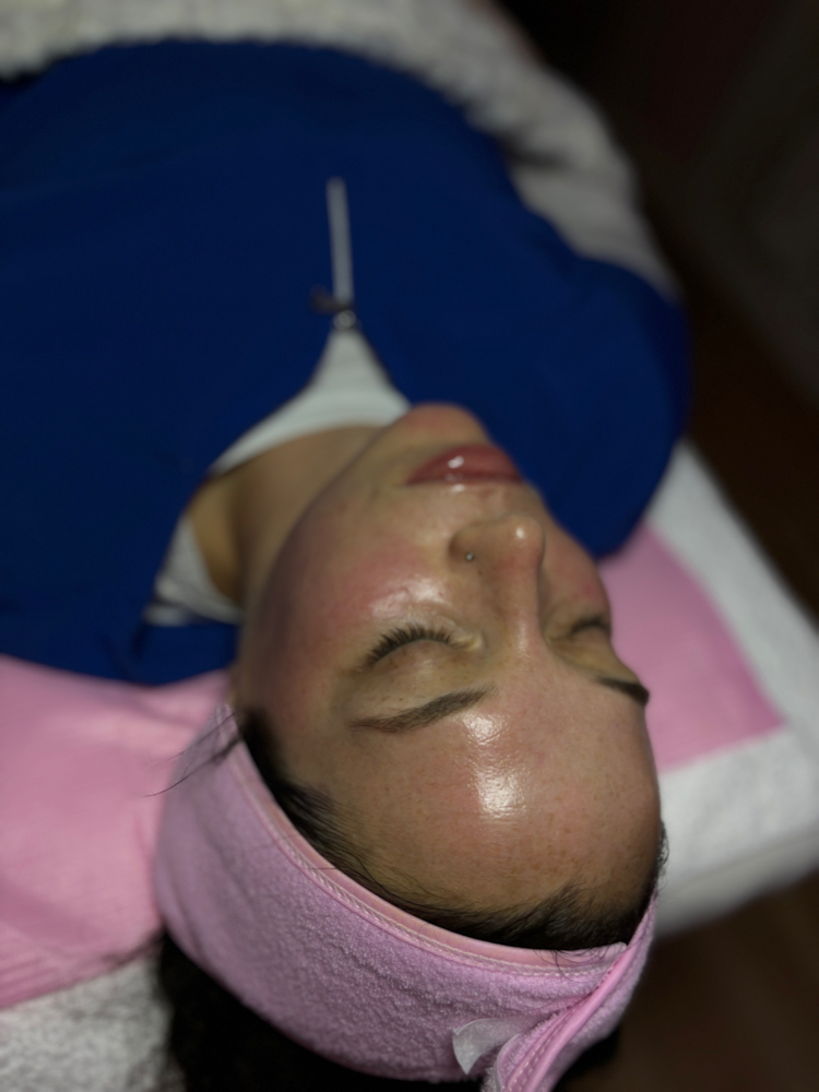 Chemical Peel