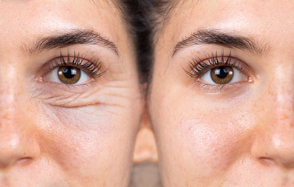 DARK CIRCLE TREATMENT/ OJERAS