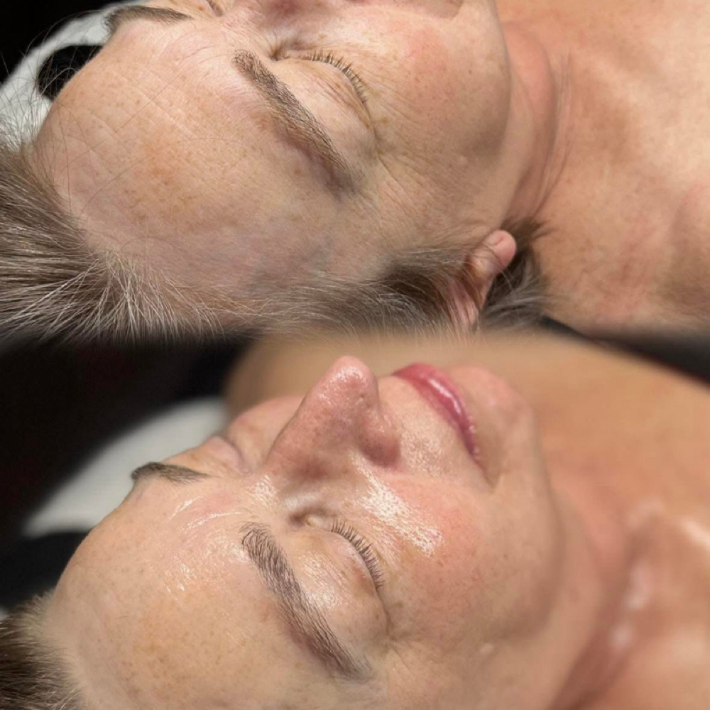 Carboxy Firming at Esthiana Skincare in Cincinnati, OH