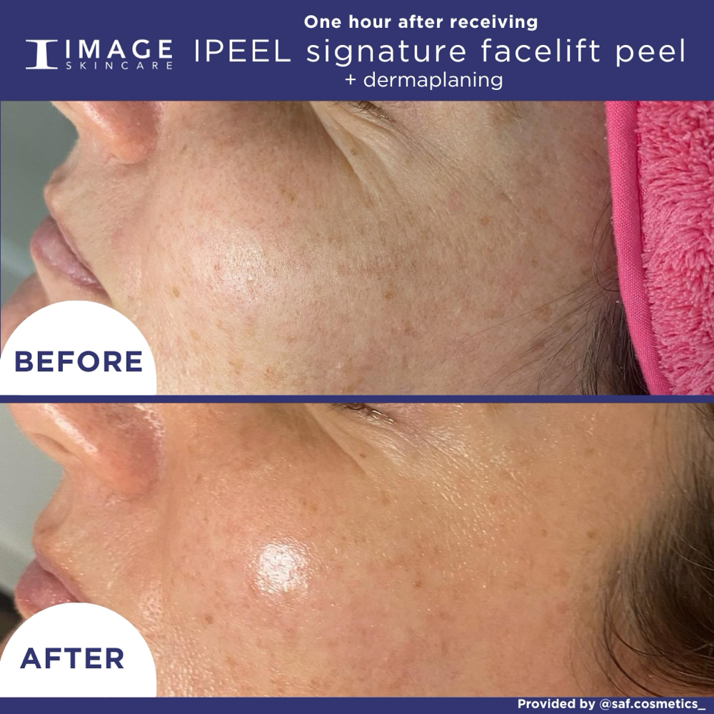 The Signature Facelift