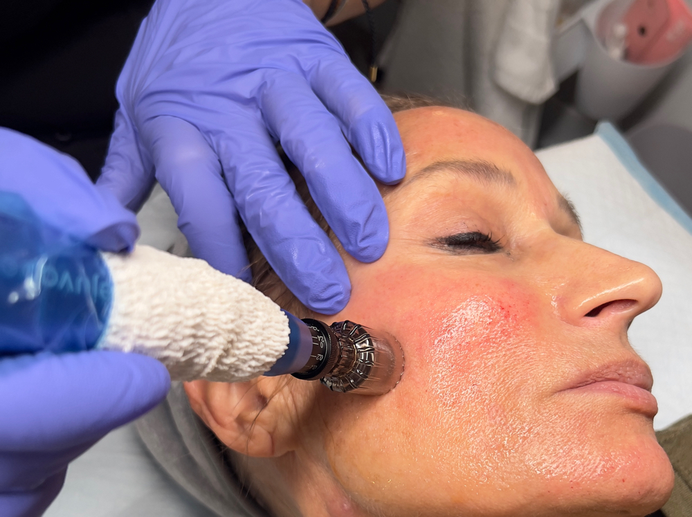 Microneedling Treatment