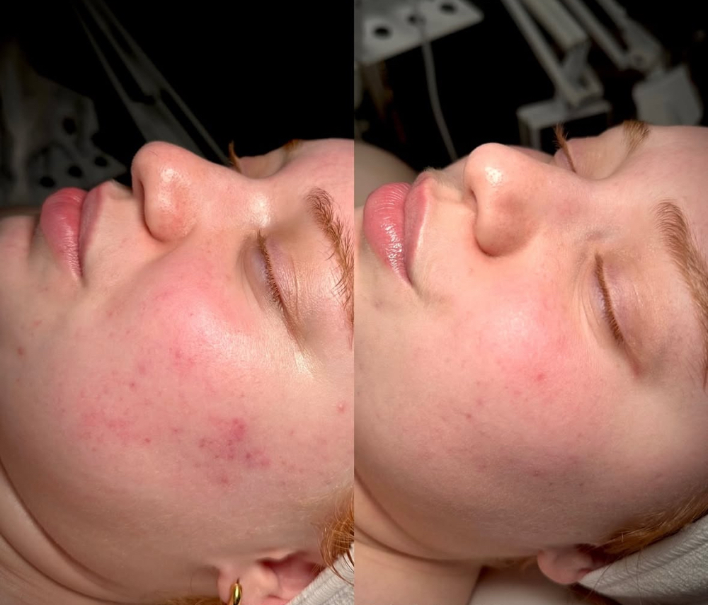 Chemical Peel Add On