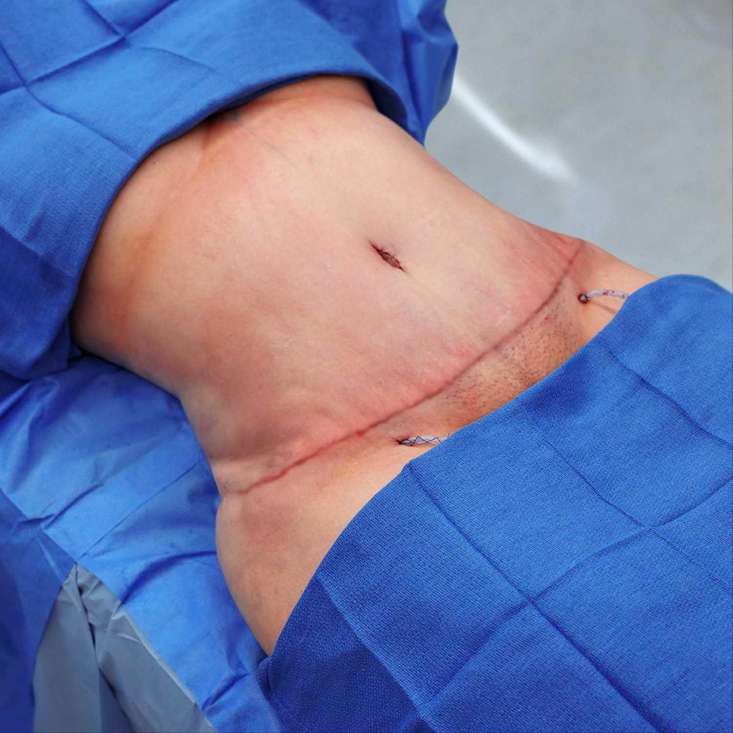 360 Tummy Tuck Scar CoverUP at Cosmetic Studio 54 in Los Angeles, CA