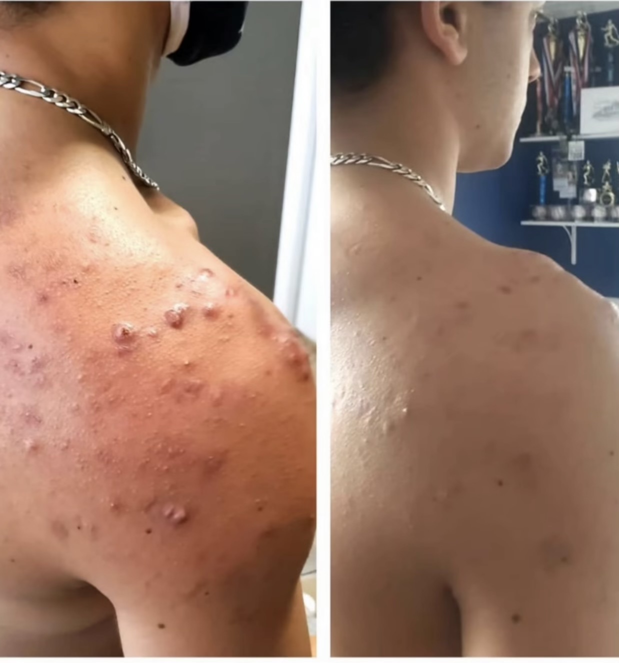 Cryotherapy Acne Relief