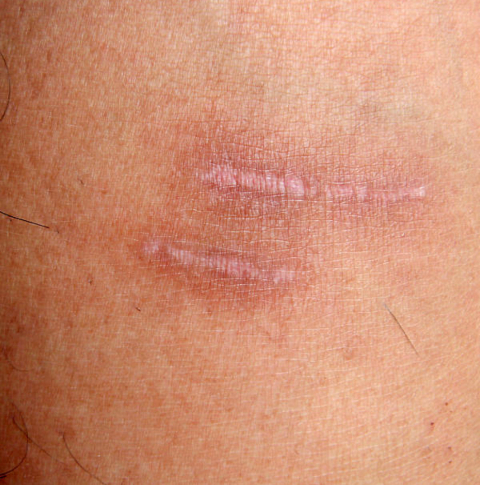 Small Scar Lightening Session