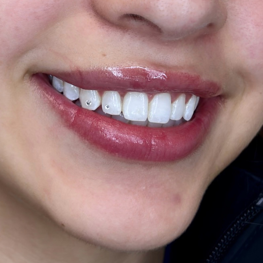 Enhancement — Extra Sparkle at Luna Smiles in Lexington, SC