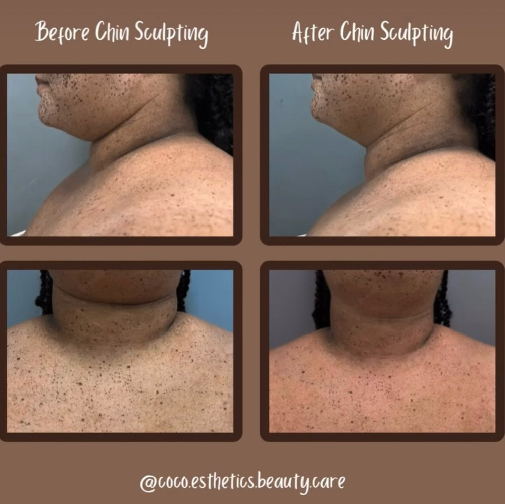 Chin Sculpting