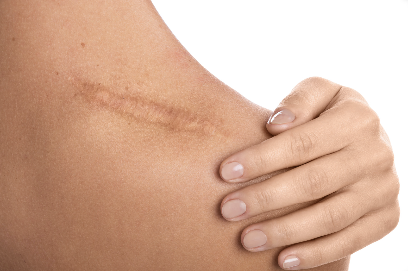 Scar Therapy