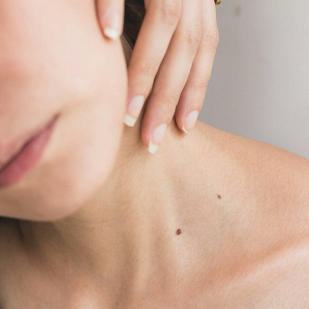 SKIN TAG REMOVAL at Aether Aesthetics in Midland, TX