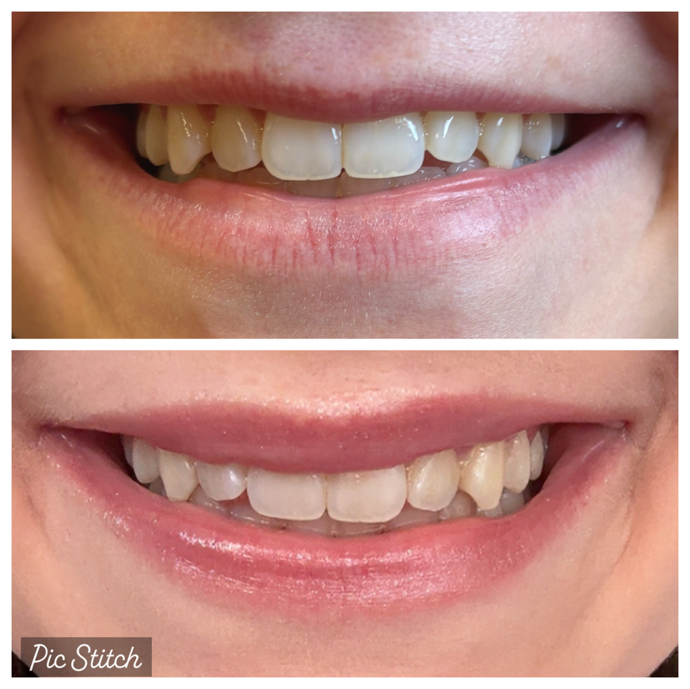 Lip Flip (Top & Bottom)