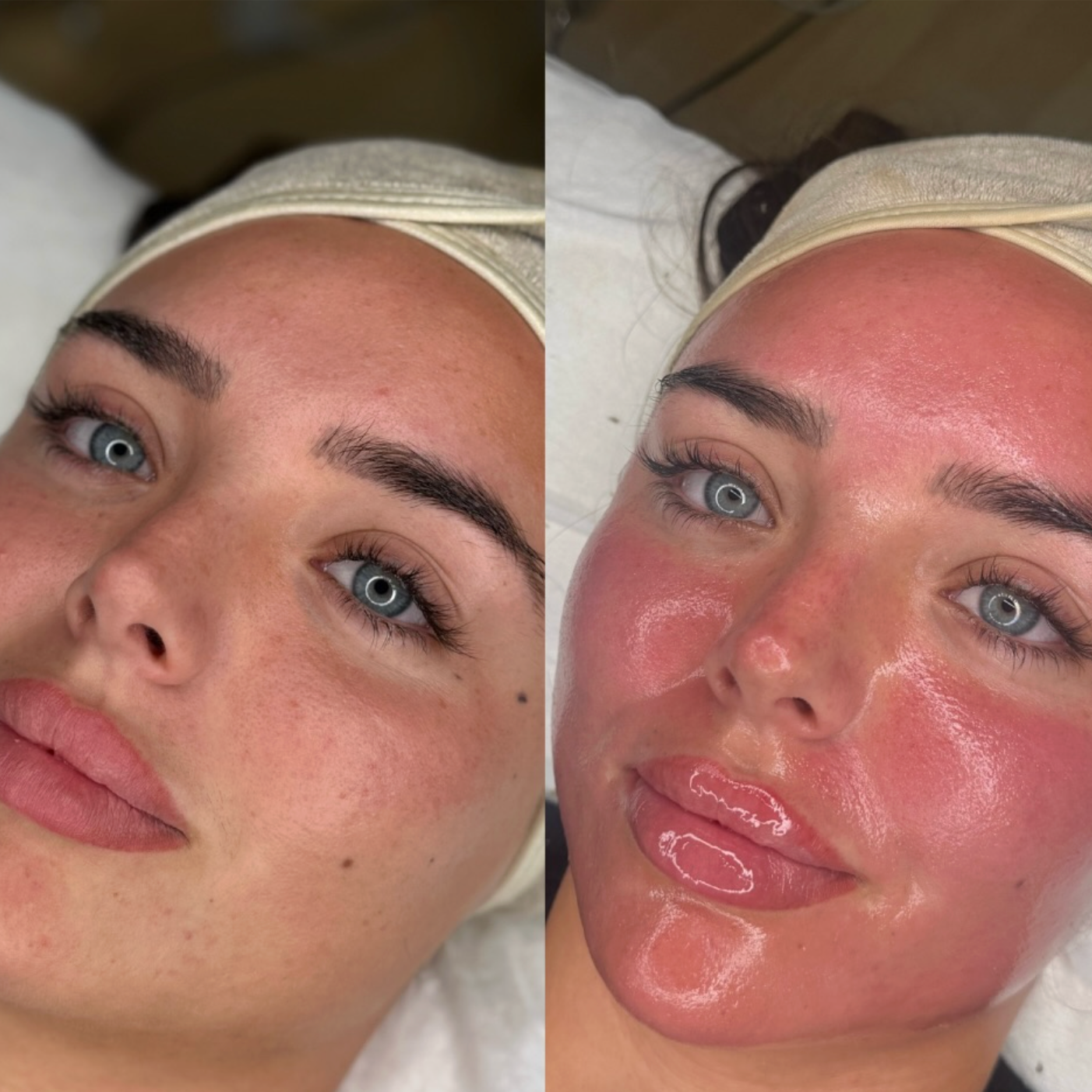 Microneedling at Idaho Beauty Lounge in Eagle, ID