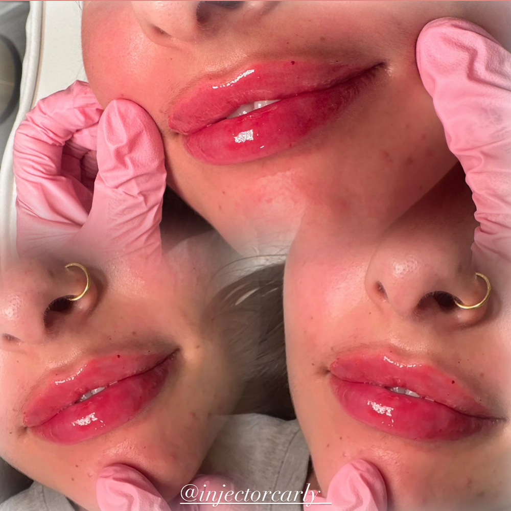Lip Flip