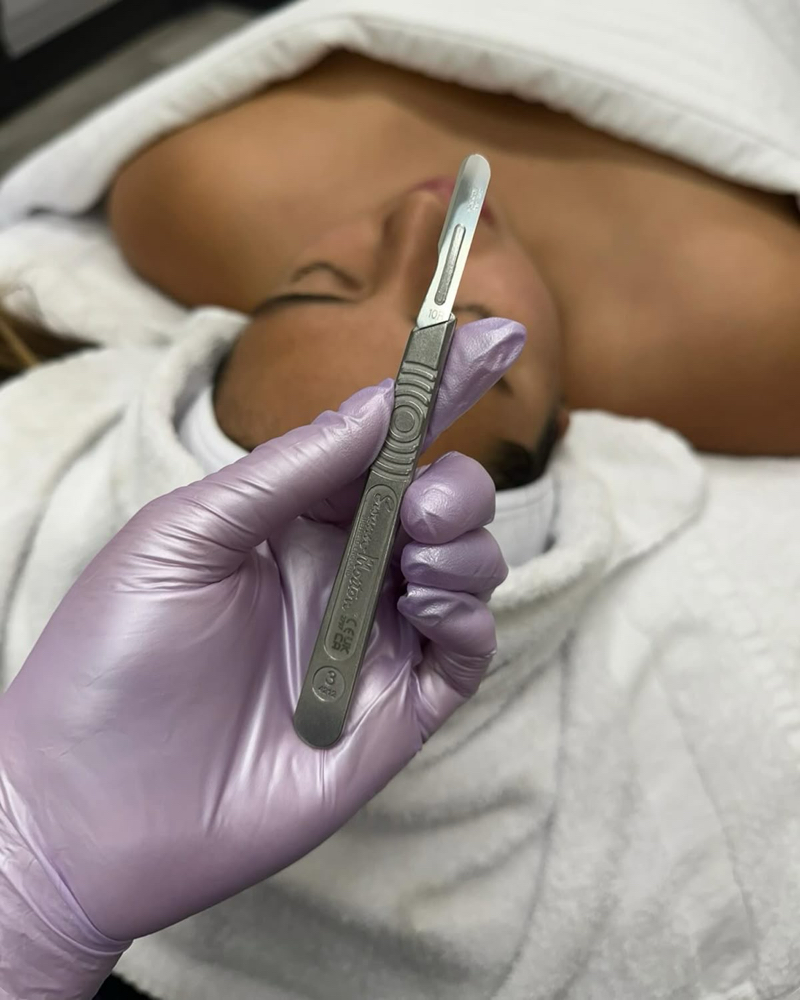 Dermaplaning