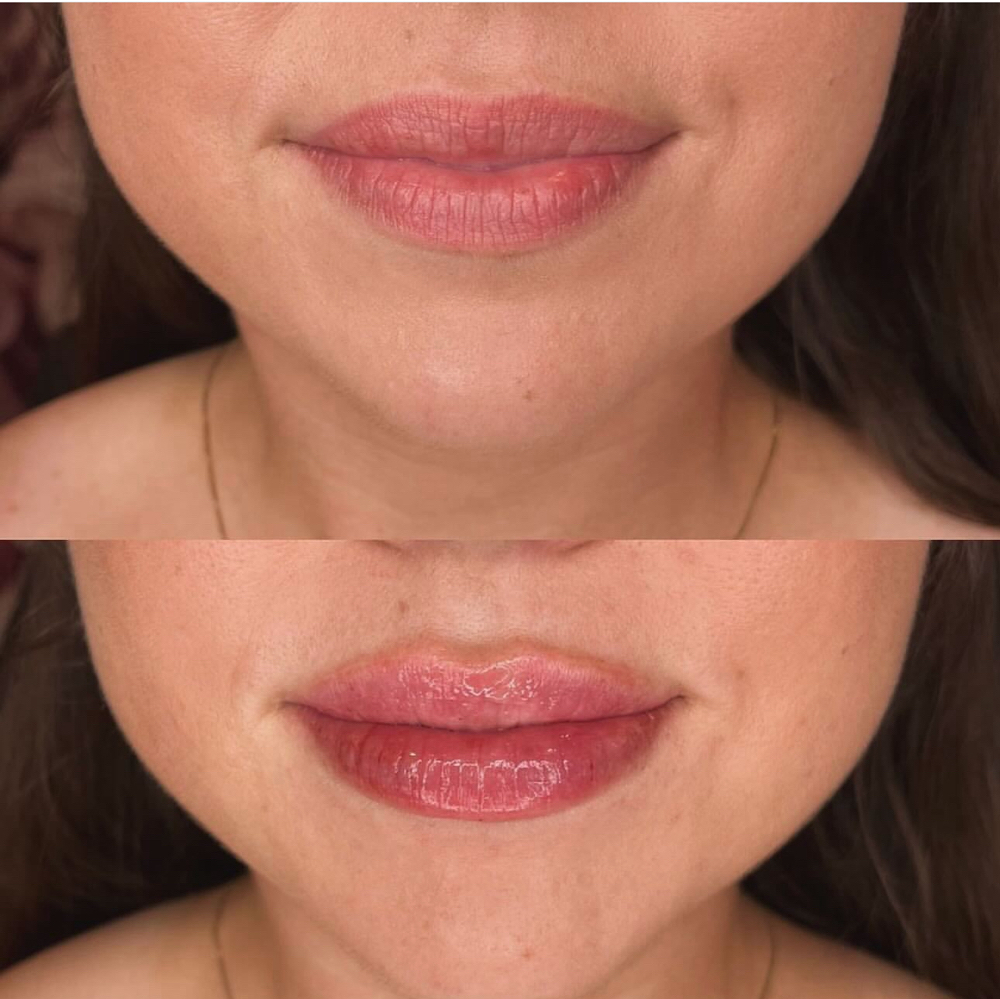 Natural Lip Filler