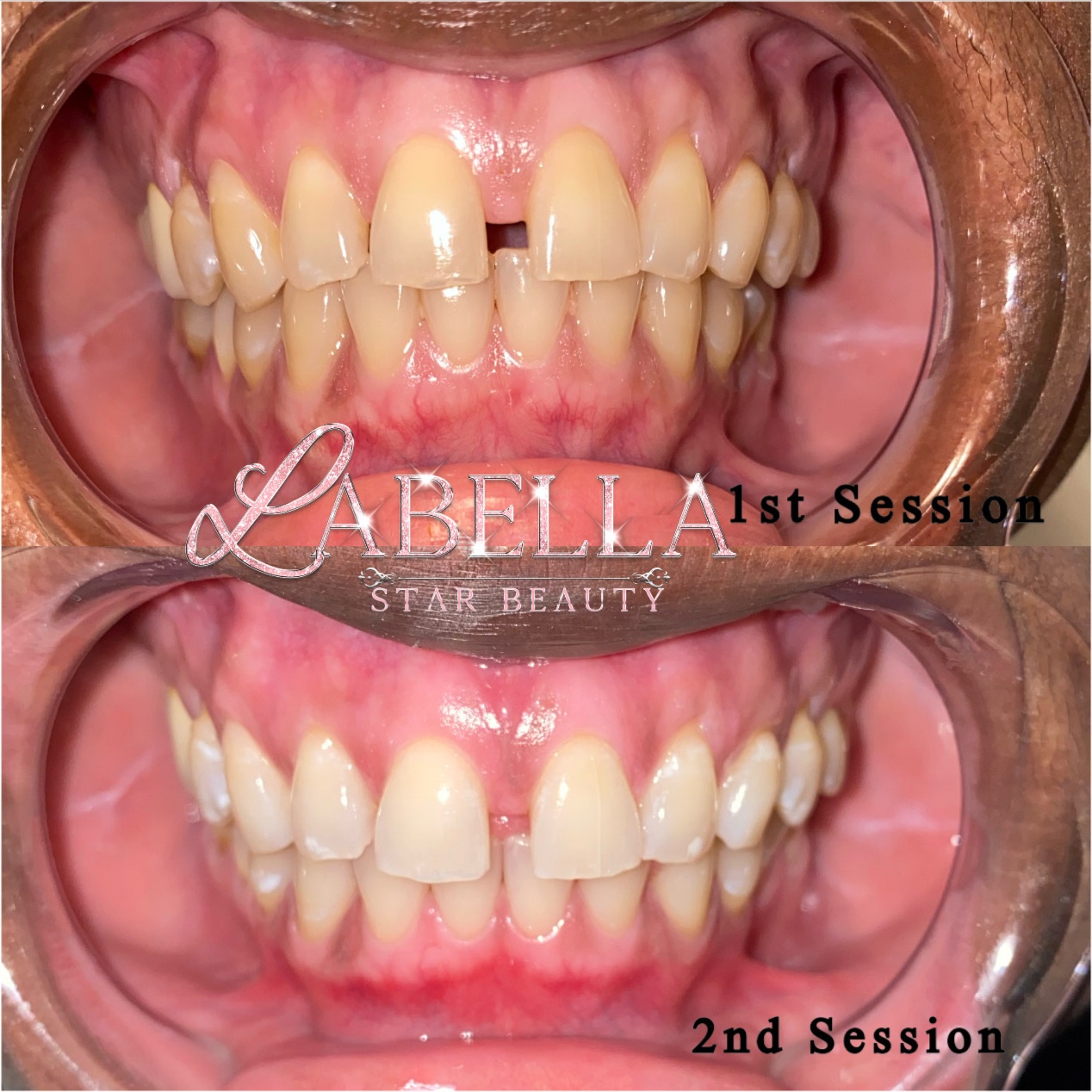 Laser Teeth Whitening