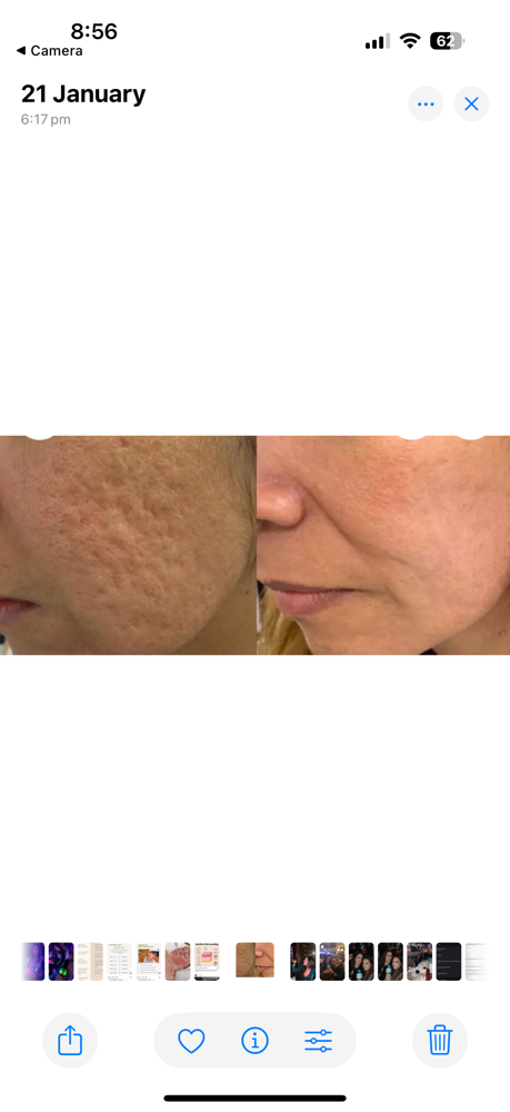 Microneedle