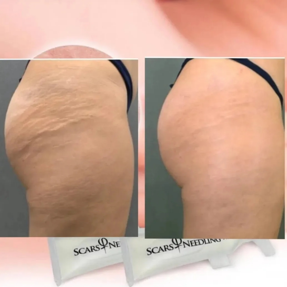 Microneedling StrechMark Bottom X1