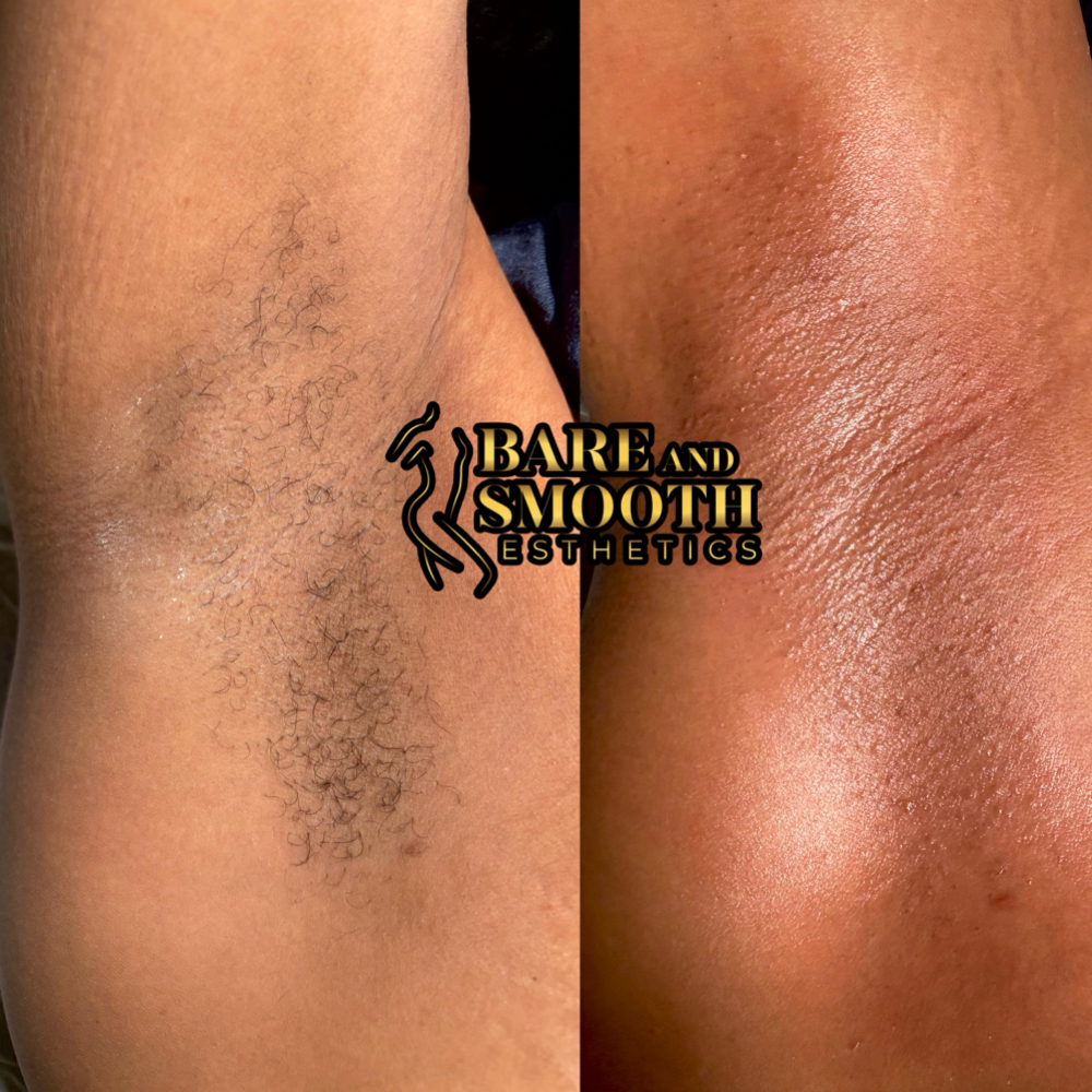 Underarms at BARE AND SMOOTH ESTHETICS LLC in Lombard, IL