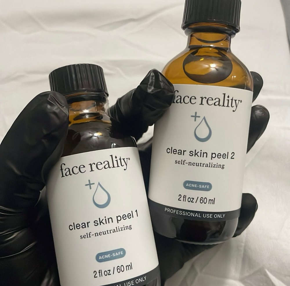 Acne Bootcamp Peel