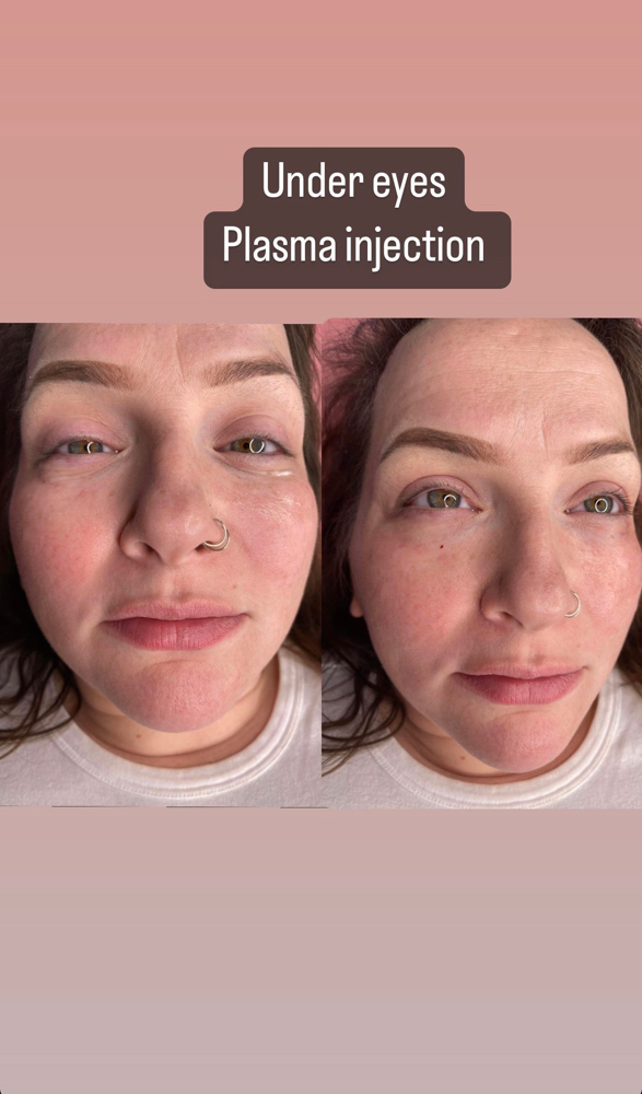 Plasma Eye Injection