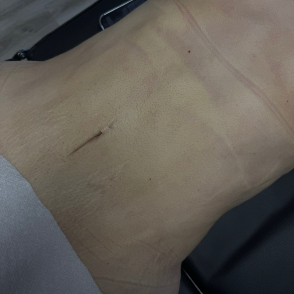 Post Op Lymphatic Massage(1Massage) at Liminluxx in Dallas, TX