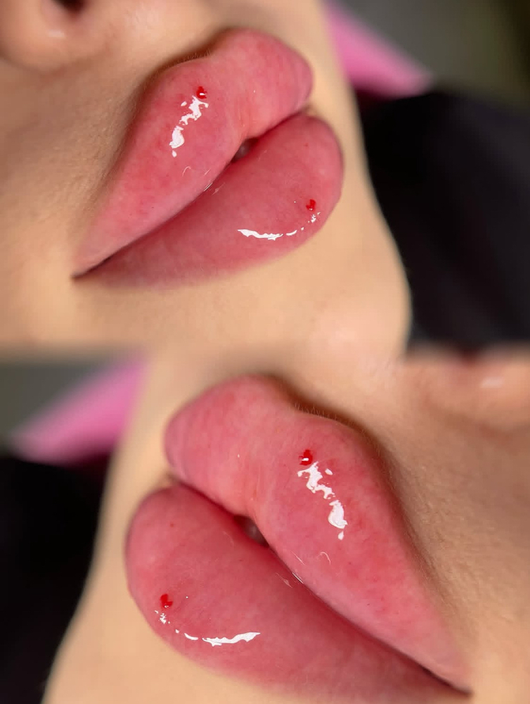 Lip Filler