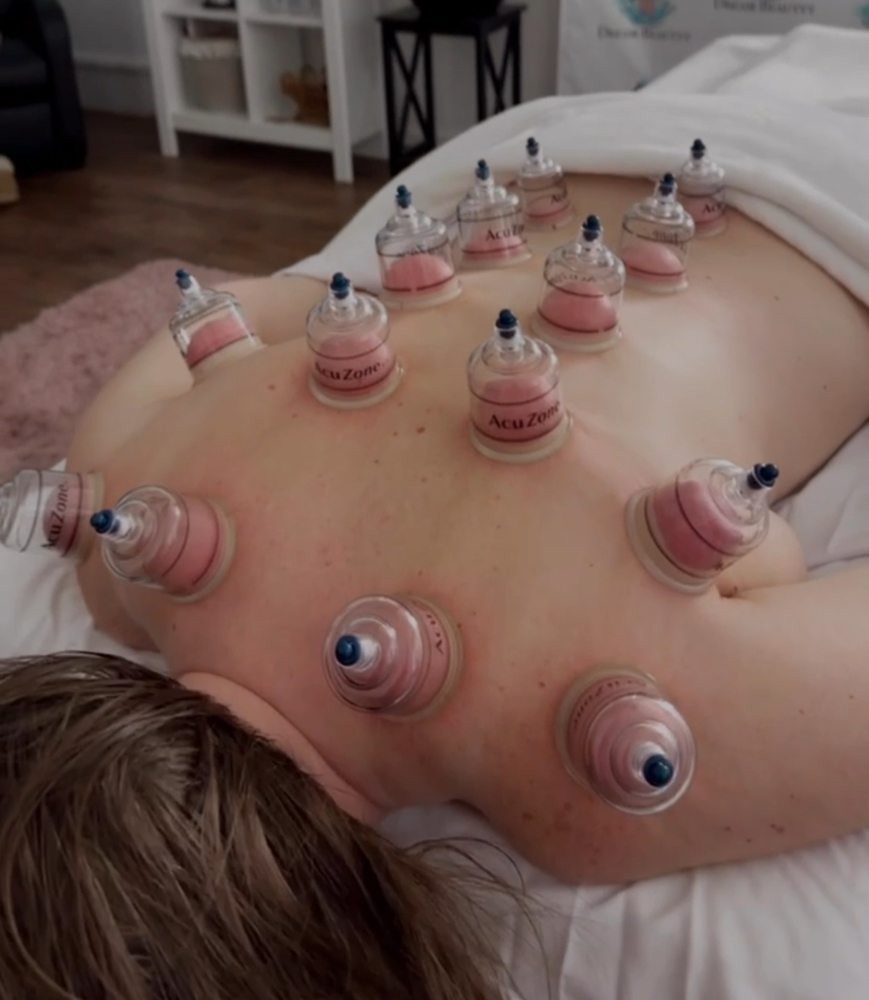 Cupping