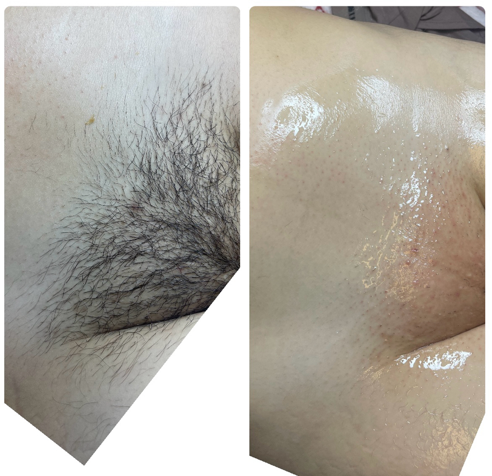 Brazilian Wax