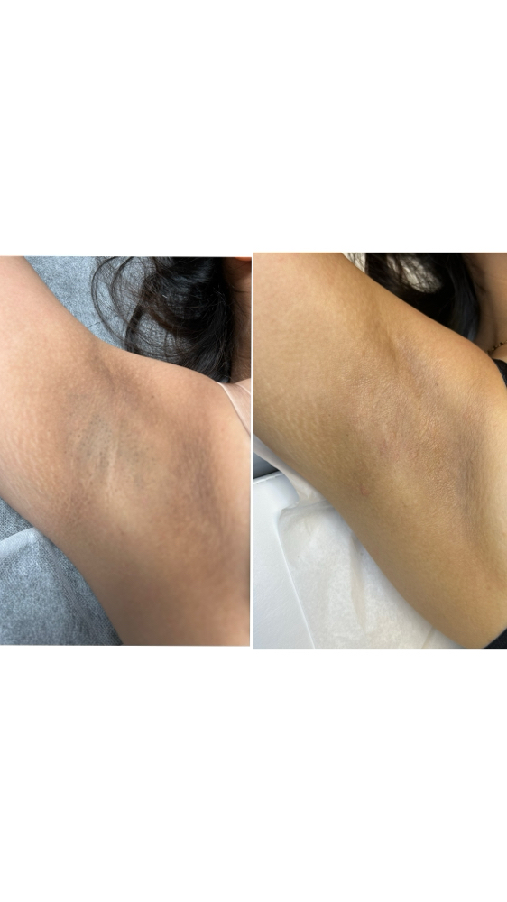 Bleaching Under Arm(axilas)