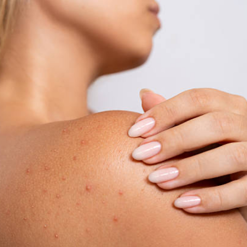 Backne Treatment at anasko skin studio in Dallas, TX
