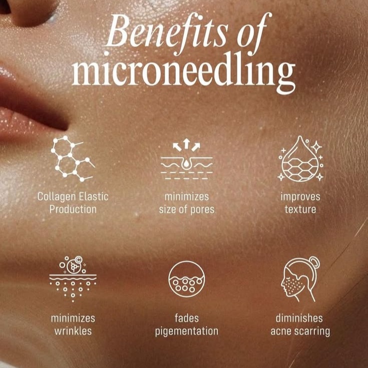 microneedling + mask at shannyb_ esthetics in Fond du Lac, WI