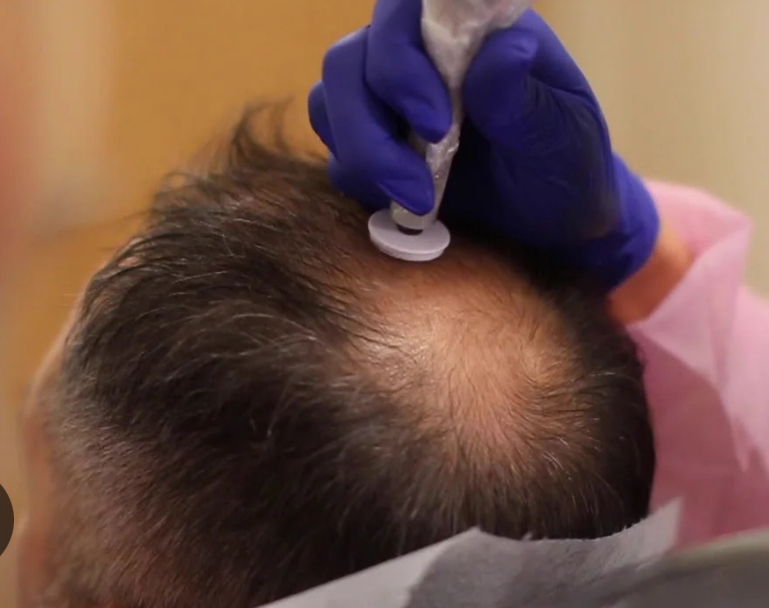 Procell Hair growth W/Exosomes-Full