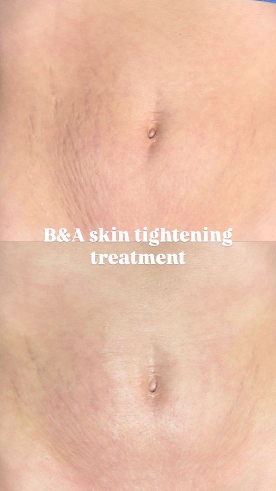 Stomach Revision Treatment